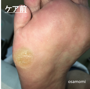 昭島市で胼胝・魚の目は、オサモミ整体院。