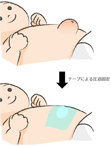 臍ヘルニア 茨木市の小児科 はら小児科クリニック