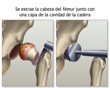 ARTROPLASTIA DE CADERA