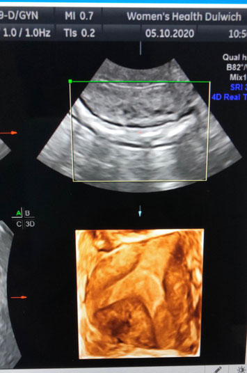 4D Gynaecology Ultrasound