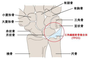 手首の小指側の痛みが出る一例（三角線維軟骨複合体損傷：TFCC）の部位を示したイラスト
