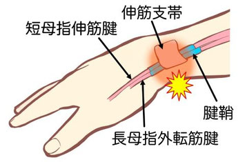 手首の親指側の腱（短母指伸筋腱・長母指外転筋腱）の腱鞘炎を起こしている様子のイラスト