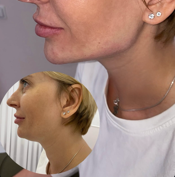Straffung Kinn und Wangenknochen Jawline mit Kombination Radiesse und Fettbehandlung und Morpheus 8