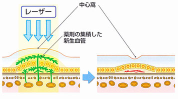 加齢黄斑変性症の治療法。レーザーによる光線力学的療法（ＰＤＴ）