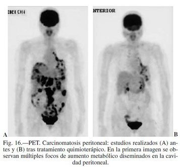 PET. Carcinomatosis peritoneal