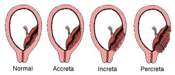 Placenta previa