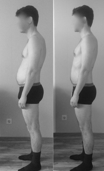 Linke Seite vor, rechts kurz nach der 1. Faszientherapie Sitzung