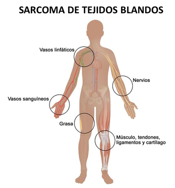 sarcoma de tejidos blandos