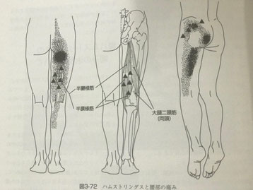 トリガーポイント関連痛のイメージ画像