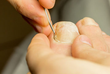 Eingewachsener Zehennagel , eingewachsener Nagel( Unguis Incarnatus) wird behandelt