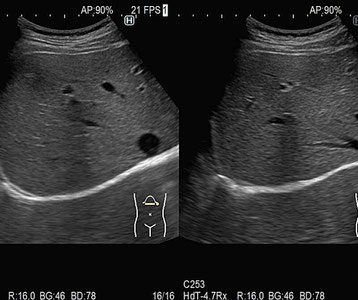 エコー、肝臓エコー、腹水