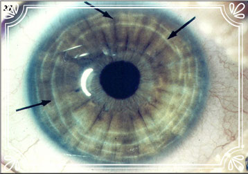 Diagnóstico iris. Problemas sistema nervioso y muscular