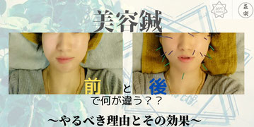 美容鍼 美容 G.L.美容鍼 金箔 金沢 石川県