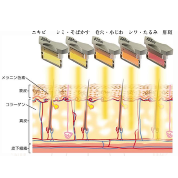 光フェイシャルとは