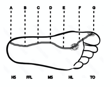 Excessively Pronated Gait Pattern