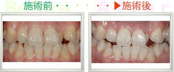 　　30代　女性　一番目立っていた八重歯が白くなりました