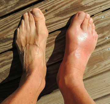 Fuß geschwollen gicht Geschwollene Füße: