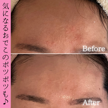 おでこのザラツキ・ポツポツケア ビフォーアフター