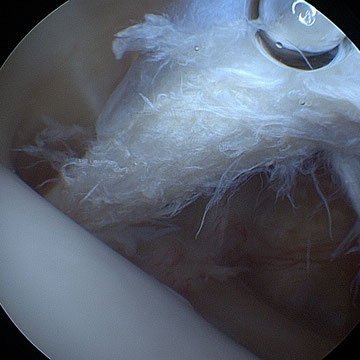 Arthroskopische Sicht mit teilrupturierter langer Bizepssehne