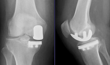 Schlitten Knie