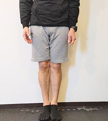 O脚矯正アフター