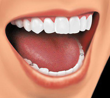 Life With Dentures 99designs 584dbea7e6ea6