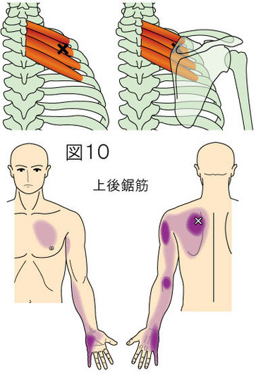 上後鋸筋トリガーポイントによる痛み