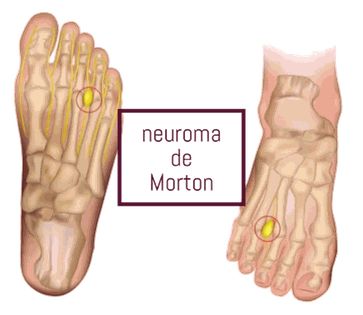 Detalle Neuroma de Morton