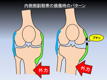 膝内側側副靭帯損傷イラスト