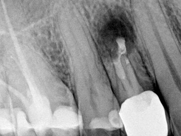 Nach der Behandlung - Wurzelspitzenresektion