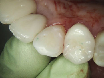Zahnarztpraxis Dr.Gune in Dallgow-Döberitz - Fallbeispiel für Kunststofffüllung nach der Behandlung
