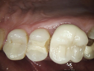 Zahnarztpraxis Dr.Gune in Dallgow-Döberitz - Fallbeispiel für zerstörte Kunststofffüllung