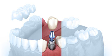 Implantate | Zahnarztpraxis im Seefeld Zürich
