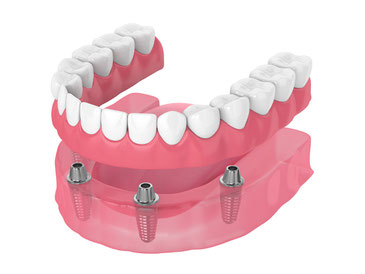 Prothesen | All-on-4 und All-on-6 – feste Zähne an einem Tag | Dr. Becker Zürich