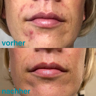 Vorher Nachher Bilder Ganzhautlich Bewusst Schon