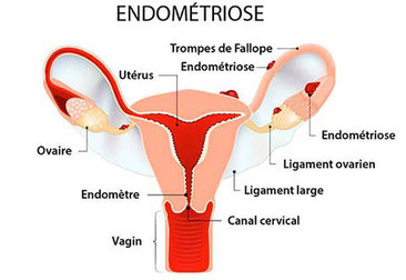 Endométriose, utérus et ovaires, trompes atteints par l'Endométriose