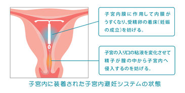 ザクリニック-子宮内避妊システムなどのその他避妊指導も行っています