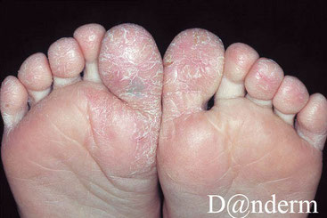 dermatose plantaire juvenile