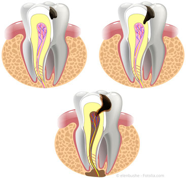 Bakterien aus einer Karies dringen in die Pulpa ein und führen zur Entzündung