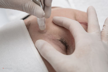 Microneedling hilft bei Hautproblemen jeglicher Art.