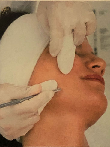 Microneedling in Binningen/Basel für sichtbare Hautergebnisse!