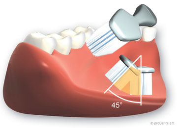 Borsten mit ca. 45 Grad Richtung Zahnfleisch ansetzen (© proDente e.V.)