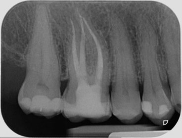 Wurzelbehandlung Zahnarzt Wulften Die Praxis Fur Prophylaxe Fullungen Und Zahnersatz