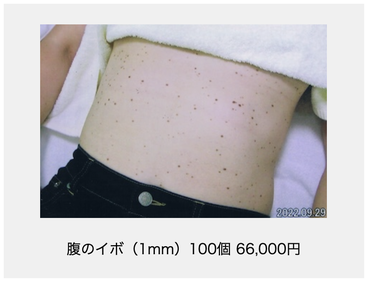 腹のイボ