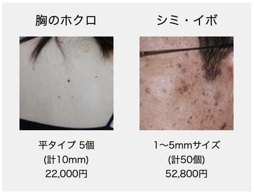 胸のホクロ、顔のシミ・イボ