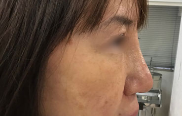 鼻プロテーゼ術後１週間（右側面）