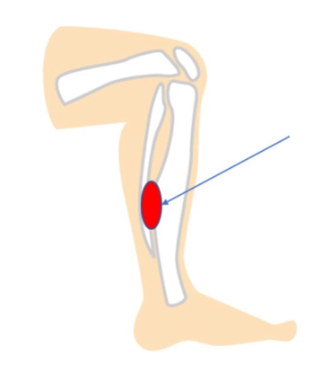 シンスプリントは脛の内側に痛みが生じます