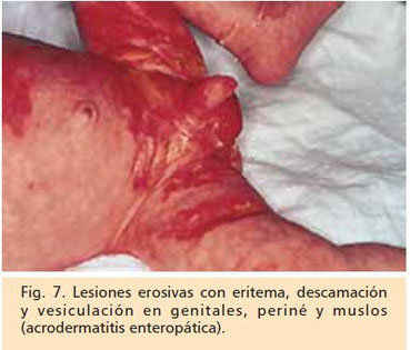 acrodermatitis enteropatica