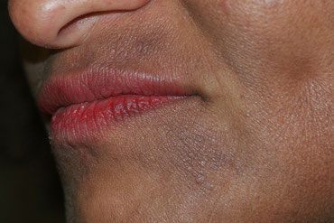 eczema peau foncee de couleur grise