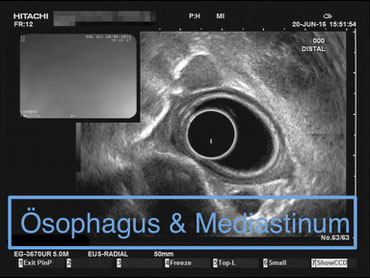 Endosonographie Bilder Normalbefund Ösophagus Mediastinum